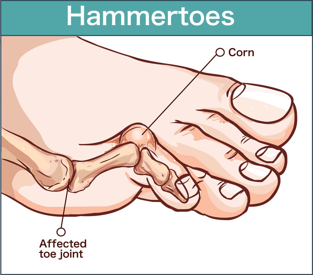 Hammertoe Treatment - Island Foot Clinics