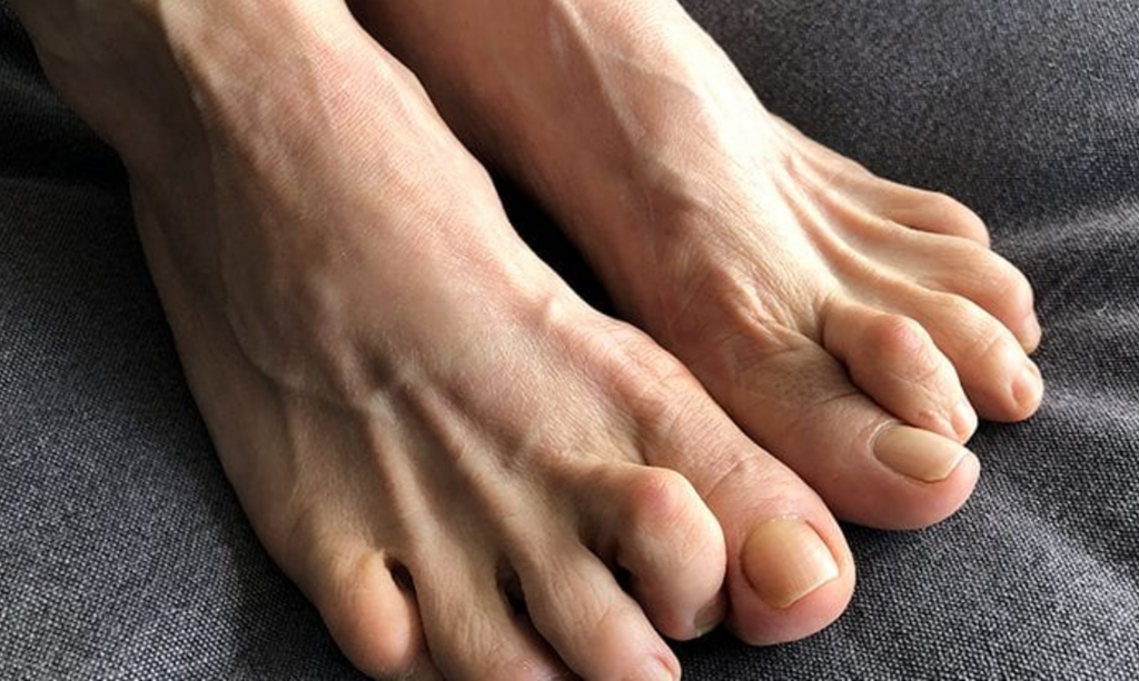 Types of Hammertoe Surgery and What You Can Expect for Recovery
